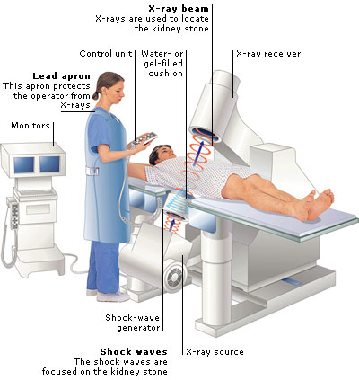 ESWL Extracorporeal shock wave lithotripsy - Litotripsia - Uroclinic Clinica Urologie-01