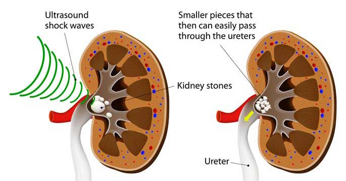 ESWL-Extracorporeal-shock-wave-lithotripsy-Litotripsia-Uroclinic-Clinica-Urologie-02